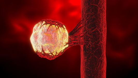 3D人体医疗血管瘤视频