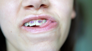 穿着牙套的美丽年轻女子肖像并检查她的舌头16秒视频