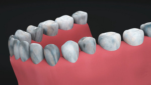 3d医疗牙齿老化动画8秒视频