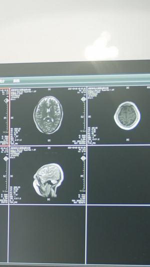 实拍电脑屏幕医疗检查结果核磁共振16秒视频