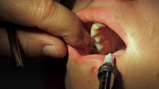 口腔外科手术闭合前牙科牙医进行麻醉注射视频