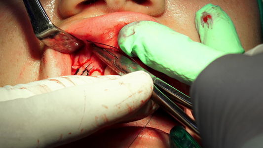 切除牙囊手术的外科手术导致缝针伤口愈合视频