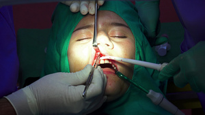 牙科植牙手术显像性口香糖手术闭合23秒视频
