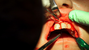 切除牙囊手术的外科手术缝针伤口30秒视频