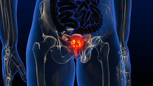 3D人体医疗膀胱癌视频