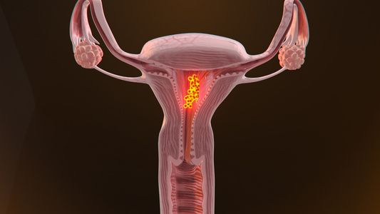 3D 人体医疗子宫肌瘤视频