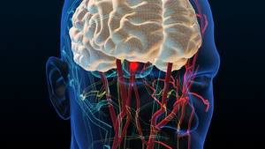3D人体医疗颅内动脉瘤20秒视频