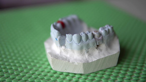 牙科牙医给病人做假呀磨具16秒视频