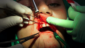 牙医医生在手术室缝合伤口18秒视频