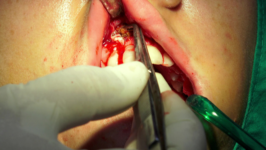 口腔外科手术暗室手术室的光谱切片在阴暗手术室内视频