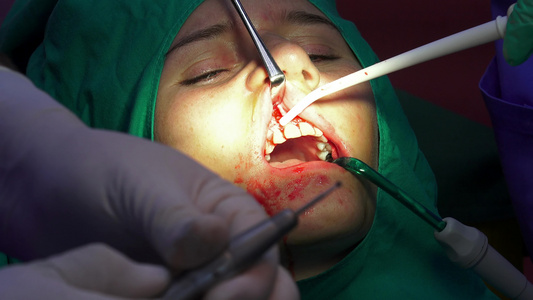 口腔外科手术暗室手术室的光谱切片在阴暗手术室内视频