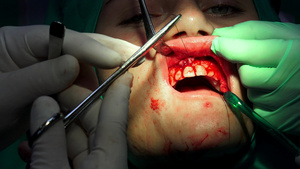 口腔外科手术30秒视频