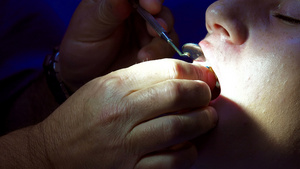 使牙科针头排入病人的牙齿20秒视频
