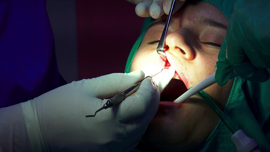 口腔口腔外科手术牙牙胶皮切除视频