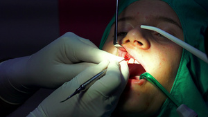 口腔外科手术脑电动切除术30秒视频