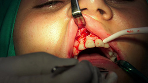 口腔外科手术脑电动切除术24秒视频