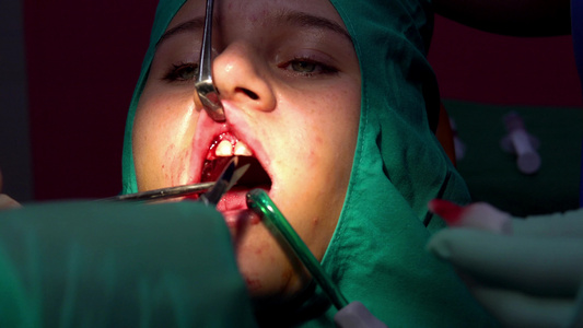 切针牙牙胶和显光性囊肿除去手术视频
