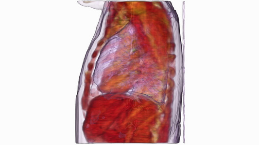 肺癌的图形重建视频