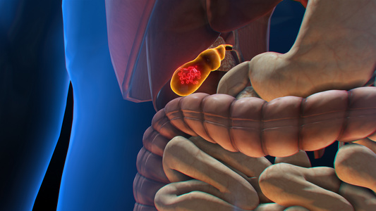 3D人体医疗胆囊结石视频