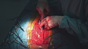 用外科工具进行心脏手术25秒视频