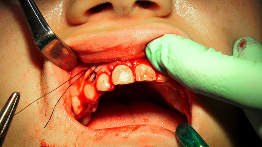 在口腔细胞切除手术后缝针缝针外科视频