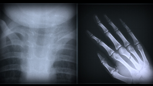 X射X光人体骨骼视频