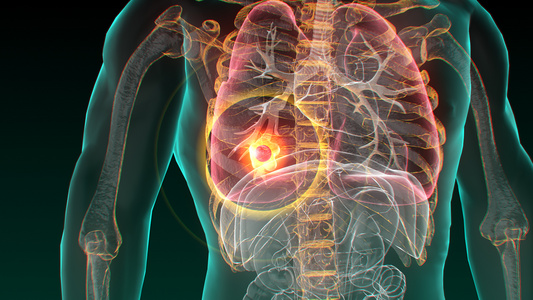 3D人体医疗肺癌[人体生理]视频