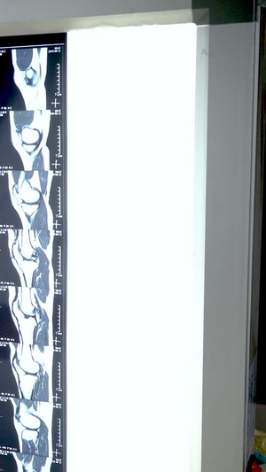 骨科医生正在讲解x光片23秒视频