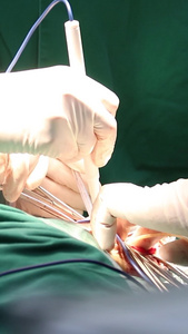 实拍医院手术室医生做手术场景视频