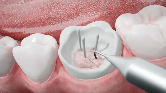 三维牙齿修复根充场景视频