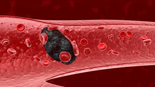 血液垃圾形成的血栓脱落后堵塞血管视频