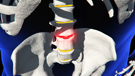 3D人体医疗腰椎间盘突出视频