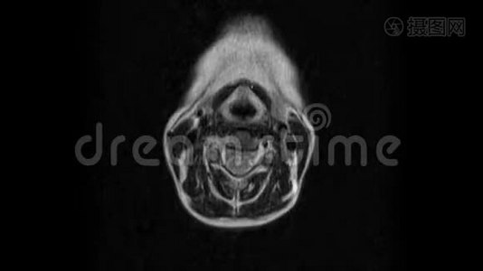 颈椎MRI检查突出和疝视频
