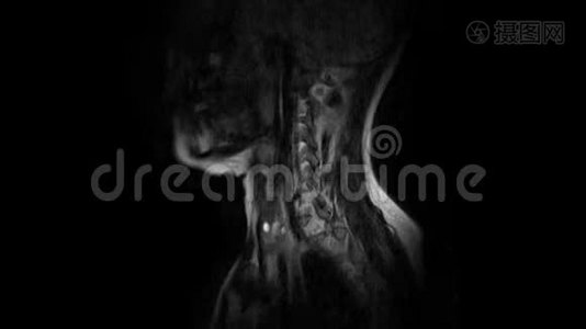 颈椎MRI检查突出和疝视频