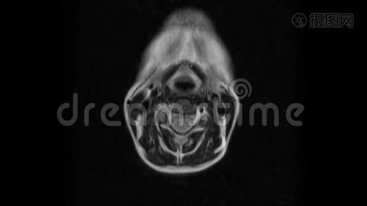 颈椎MRI的净化，突起和疝的检测视频
