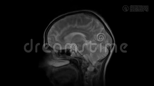 脑MRI，头部扫描和肿瘤检测.. 诊断医疗工具视频