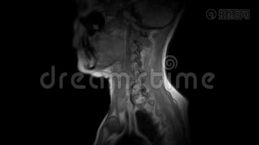 颈椎MRI检查突出和疝视频