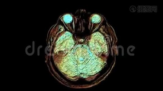 大量彩色MRI扫描大脑和头部，以检测肿瘤。 诊断医疗工具视频
