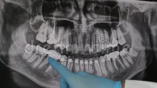 医生在监视器上显示了颌骨x光的治疗方案。视频