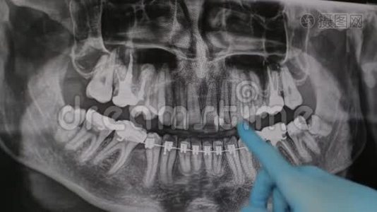 医生在监视器上显示了颌骨x光的治疗方案。视频