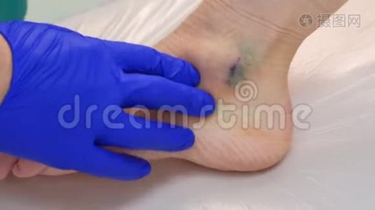 外科医生在手术后触诊腿部周围缝合，以去除脚踝湿瘤。视频