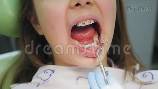 一个戴牙套的女孩牙齿的特写镜头检查视频