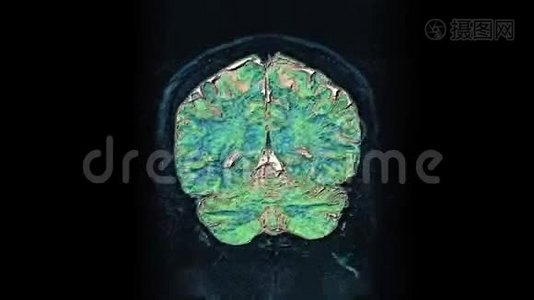 大量的彩色MRI扫描大脑和头部，以检测肿瘤。 诊断医疗工具视频