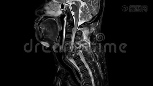 颈椎病史：一名57岁男性，有车辆事故史，共造成脊髓损伤和脊髓损伤视频