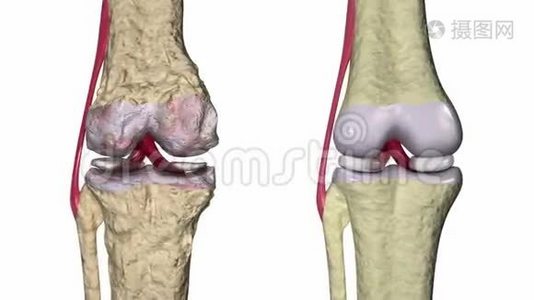 骨关节炎：膝关节伴韧带和软骨视频
