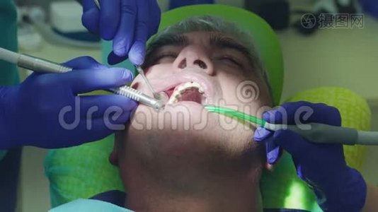 病人的牙医钻牙。 牙科医生的双手在口腔中工作视频