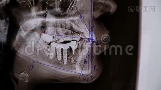 牙医展示了一个治疗牙齿横向x光的计划。 安装支架系统前的咨询视频