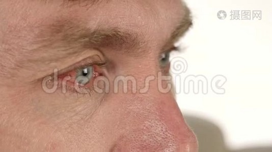 常见的眼睛感染和炎症，人滴液体药物到他的眼睛。 4K视频