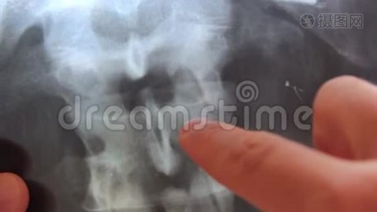 医生`他的手在X光片上显示背面的问题区域视频