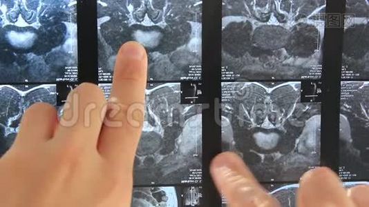 医生`他的手在X光片上显示背面的问题区域视频